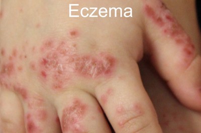 Bệnh eczema: Những thắc mắc thường gặp. Xem ngay!